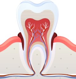 염증이 깊어져 잇몸뼈가 줄어든 치아 단면 그림