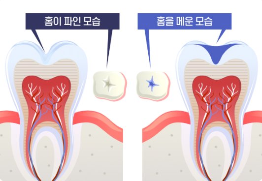 홈이 파인 어금니와 홈을 메운 어금니 비교 그림