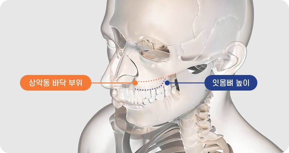 상악동 바닥 부위와 잇몸뼈 높이를 표시한 머리뼈 그림