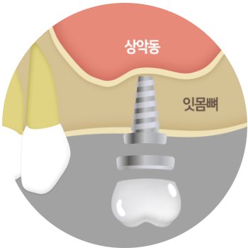 상악동 아래 잇몸뼈에 심어진 임플란트 그림