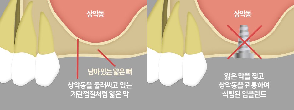 상악동을 둘러싼 얇은 막과, 막을 뚫고 잘못 심어진 임플란트 비교 그림